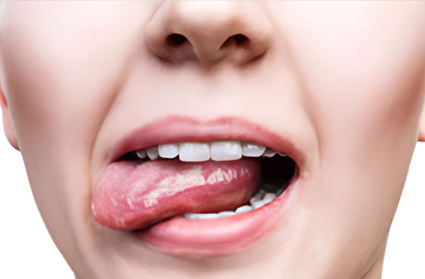 Leukoplakia